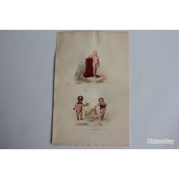 Gravure BUFFON Petite fille couverte de taches velues  XIXe si�cle